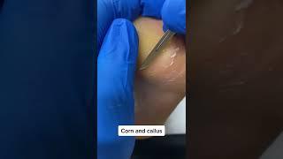 Satisfying Forefoot Corn & Callus Removal by Skilled Podiatrist #FootCare #Podiatry