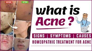 Conventional Treatments vs Homeopathic treatment for Acne | HomoeoCARE