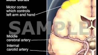 Transient Ischemic Attack and Stroke: Medical Animation