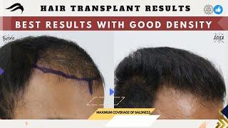 Hair Transplant In Tirupati | Best Clinic Cost Surgeon & Results Of Hair Transplant In Tirupati