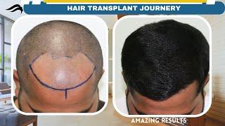 Hair Transplant In Trichy | Best Cost Results Center & Surgeon Of Hair Transplant In Trichy