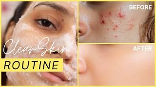 How To Remove Pimples & Acne From Face At Home | Clear Skin Home Remedies | Glamrs