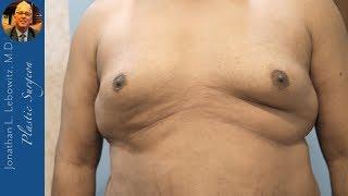 "Crazy"  IMMEDIATE Results Gynecomastia Surgery, The Long Island VaserLipo Center By Dr. Lebowitz