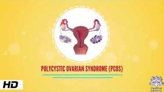 POLYCYSTIC OVARIAN SYNDROME(PCOS), Causes, Signs and Symptoms, Diagnosis and Treatment.