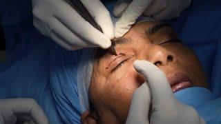 Complete Blepharoplasty Procedure - Look younger with Blepharoplasty