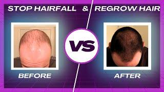 Stop Hair fall & Regrow Hair Fast | Tips