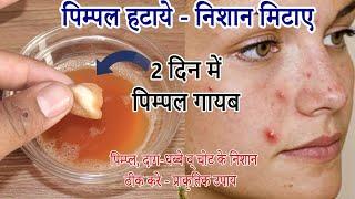 2 दिन: Pimple, Daag- Dhabbe व Scars से पाए छुटकारा पाए हमेशा के लिए । Remove Pimple - Acne Treatment