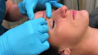 Micropeel Treatment at Maryland Dermatology Laser Skin and Vein Institute