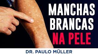 Leucodermia Solar – Manchinhas Brancas na Pele dos Braços e Pernas – Dr. Paulo Muller Dermatologista