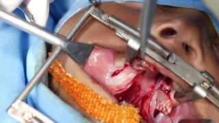 Cleft Palate Surgery: An important surgery for a cleft lip child