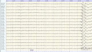 Приступ эпилепсии во время записи ЭЭГ