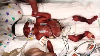 Premature twins are first in NE Ohio to receive newly approved treatment