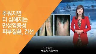 추워지면 더 심해지는 만성염증성 피부질환, 건선 - (20121110_435회 방송)_평생의 고통, 건선