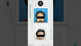 Guaranteed Hair Transplant Result | Dr. Rashmi Aderao Skin, Hair & Laser Clinic Pune