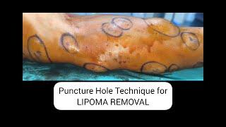 20 MINUTES 25 LIPOMA REMOVAL | MULTIPLE LIPOMA REMOVAL #lipo #LIPOMA #pimplepopping #pimplepopper