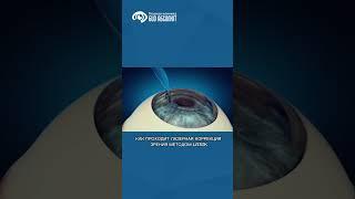 #лкз_биоабсолют #лазернаякоррекция #Lasik #офтальмолог #офтальмологическийцентр