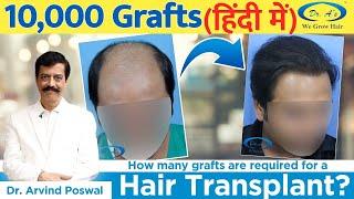 Hair Transplantation of 10000 Grafts | Best Hair Transplant Treatment in Delhi | Dr.A's clinic