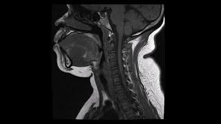 Cervical Spine MRI: Normal (No Pathology)