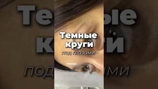 Как убрать темные круги под глазами? #темныекруги #отеки #мешкиподглазами