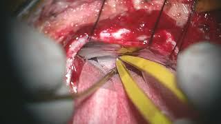 Lateral Supracerebellar Approach for Resection of a Pineoblastoma (Preview)