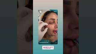 "Ultimate Facelift Transformation | Look 10 Years Younger!" Prof.Dr. Süleyman TaŞ