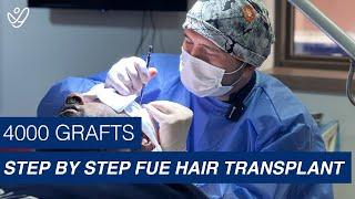 Step by Step FUE Hair Transplant | 4000 Grafts