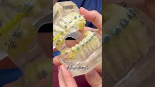 Хотите поставить брекеты, но не знаете какие?