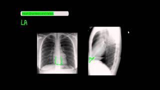 Identifying Heart Chambers and Heart Valves on Frontal and Lateral Chest X-Rays [UndergroundMed]