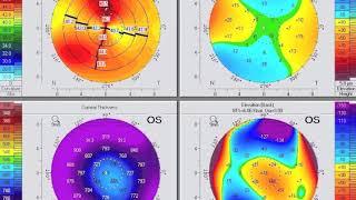 Post DSAEK transepi topo-PRK. How to improve refraction and optical quality.