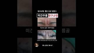 미간주름교정 전후모습 비교 #관상성형 #미간주름영구교정 #미간필러부작용 ##신촌성형외과 #은평성형외과 #홍대성형외과 #연자연미