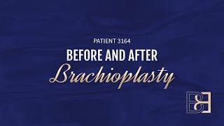 Brachioplasty (Arm Lift) {Patient 3164} Before & After