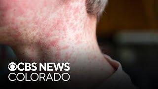 Colorado health officials confirm seventh measles case, on flight with others infected