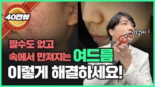 짤 수 없는 여드름은 어떻게 해결할까요? | 여드름 치료, 여드름 없애는 법