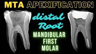 MTA APEXIFICATION | Mandibular First Molar | Apexification Step by Step