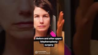 Before & After: Upper Blepharoplasty Surgery