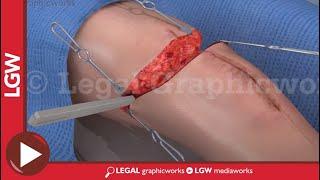 Above the Knee Amputation Surgery 3D animation