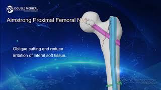 Double Medical Aimstrong Proximal Femoral Nail ( APFN )