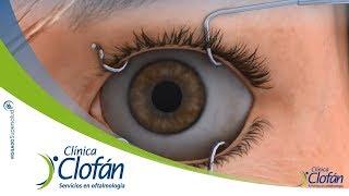 Cirugía LASIK