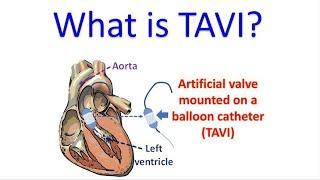 What is TAVI?