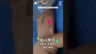 하찮은 손가락 우정문신 문신 제거 [Laser Tattoo Removal]