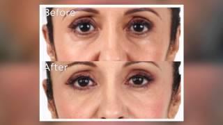 Non-Invasive Injectable Fillers for Volume Loss | Maryland Laser Skin & Vein