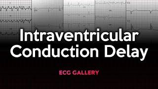 Intraventricular Conduction Delay: ECG Gallery