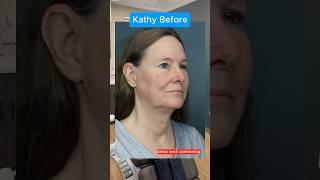 The Real Facelift Results After 5 Weeks (Interview)