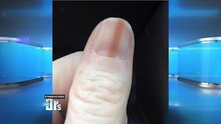 Melanoma on Your Nail?