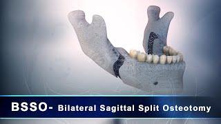 BSSO-Bilateral Sagittal Splitting Osteotomy | 3D  Dental Animation