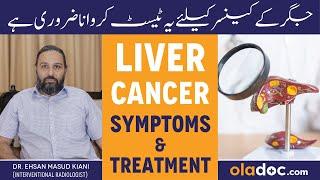 LIVER CANCER Symptoms And Treatment - Jigar Ke Cancer Ka Ilaj - Liver Failure Kaise Hota Hai