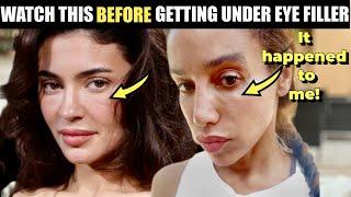 How to Avoid Kylie Jenner's Swelling from Tear Trough Filler- How I Fixed My Under Eye Filler