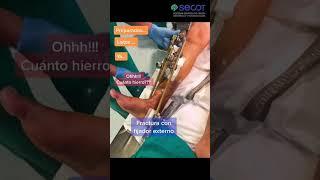 Fracturas de pilon tibial… hierros… hierros y más hierros!!!
