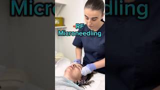 FRACTIONAL RADIO FREQUENCY MICRONEEDLING Scar-Free, Wrinkle-Free, Worry-Free. Boost Collagen!