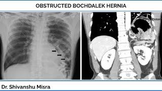 OBSTRUCTED BOCHDALEK HERNIA | DR SHIVANSHU MISRA